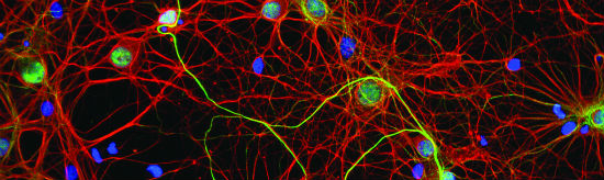 Alzheimer's disease trigger found alzheimer's disease, cause of, brain plaque, toxic oligomers