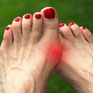 Image of two feet, one red with bunion pain. ppma private physicians medical associates