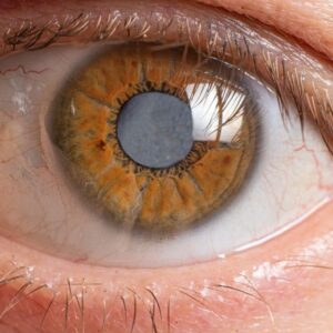 Close-up image of a cataract on a human eye. eye health and nutrition Author Romana Brennan MS RD. PPMA Private Physicians Medical Associates. Concierge Medicine, Newport Beach California.
