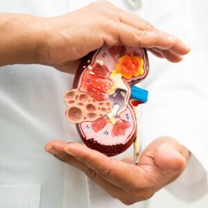 An image showing a doctor's hands holding a kidney model to explain chronic disease
