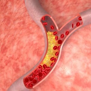 A medical drawing of cholesterol in arteries.