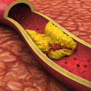 A digital image of an artery clogged with cholesterol. Heart Health Boost: Transform Your Life with Regular Exercise